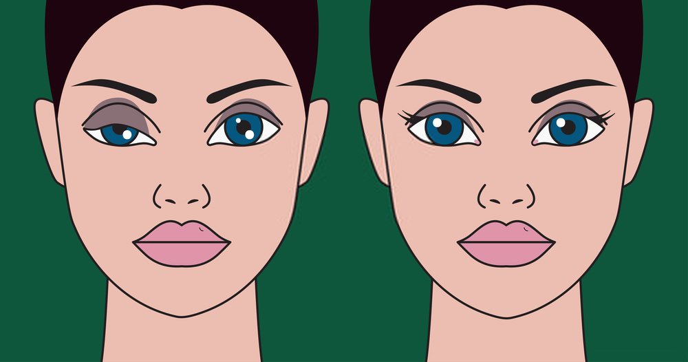 before and after ptosis repair