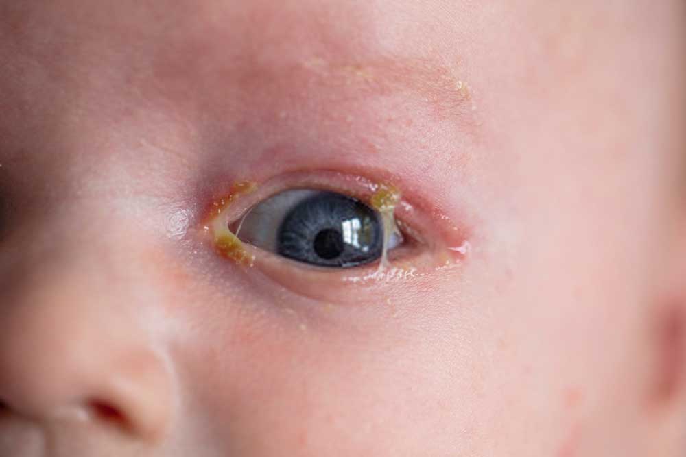 Sticky Eyes In New Born Babies Symptoms, Reason and Treatment